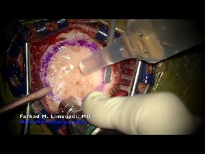 Surgical removal of a malignant brain tumor (glioblastoma multiforme or GBM) in a young patient.