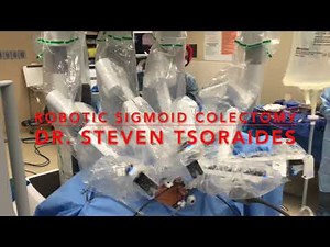 Robotic Sigmoid Colectomy with Intracorporeal Anvil Anastomosis