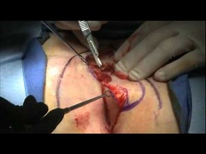 Bascom Cleft Lift Pilonidal Surgery Short Video