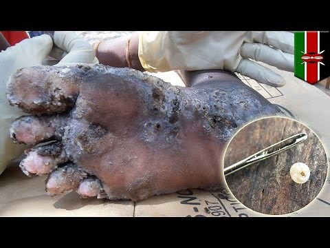 Shocking images reveal parasitic ‘jigger’ fleas burrow into human skin