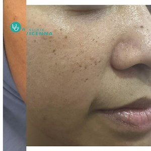Fr-eckles bahaya ? Fr-eckles adalah bintik-bintik coklat dan timbul jelas apabila kulit terdedah kepada cahaya matahari. Keadaan ini tidak berbahaya dan hanya disebabkan kerana penghasilan melanin yang berlebihan. 👉🏻Pelbagai warna dan bentuk 👉🏻Genetik 👉🏻Tidak bahaya Tapi, kalau korang rimas dan rasa down untuk hilangkan fr-eckles tu, korang boleh je pudarkan/hilangkan ia dengan rawatan tertentu seperti l*ser 😎. #picolaser #pigmentation #acnescar #acne #jerawat #parutjerawat #jeragat #mela