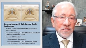 In this video, Dr. Bahman Guyuron discusses, “The Soft Triangle Tension Graft,” by Ghavami, Vranis; and Villanueva, which appears in the August 2025 issue of Plastic and Reconstructive Surgery, Volume 156 Issue 2. Read it: https://bit.ly/SoftTriangle #plasticsurgery #videodiscussion #PRSJournal #nosesurgery #Rhinoplasty #onlyinprs | Plastic and Reconstructive Surgery
