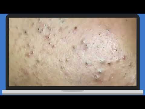 Punti Neri, Acne, Blackheads Removal pt.2