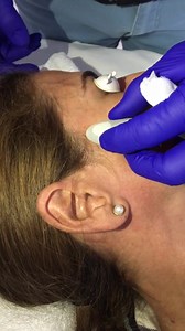 Eliminación de lentigo solar con Láser | Dr. Jean Paul Osores