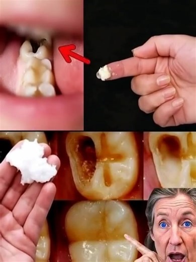🔴Comment réparer une carie naturellement...Voir plus | Tu vas Aimer