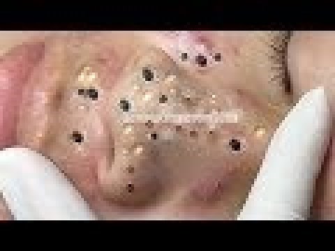 Black head removed from nose / Loan Nguyen latest video #0629/ cystic blackheads whiteheads removal