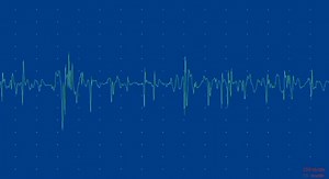39K views · 364 reactions | A 32-year-old male patient presented with progressive proximal lower limb weakness and a positive Gowers sign. The triad of EMG, MRI, and ultrasound findings all point toward a chronic myopathic process. EMG in myopathy - MUAPs with low amplitude, polyphasia, short duration, and early recruitment. Classic electrical signature of a myopathic process. https://www.instagram.com/p/DSEetWMDCfg/?igsh=MTZoMThpcTh5OTdmaw== | Neurology | Facebook