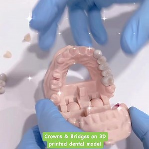 DENTAL CROWNS & BRIDGES Hari ni doc nak share mengenai crown &...