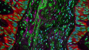 91K views · 458 reactions | ALK + Lung Cancer and Drug Resistance—a clinical trial to help doctors and patients make more informed treatment decisions. | GO2 for Lung Cancer | Facebook