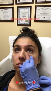  4D Under Eye Lift™ as part of non-surgical facelift (Liquid...