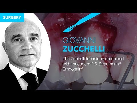 The Zuchelli technique combined with mucoderm® & Straumann® Emdogain® - by Prof. Dr. G. Zucchelli