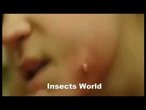 Botfly Removal . Gross,But satisfying