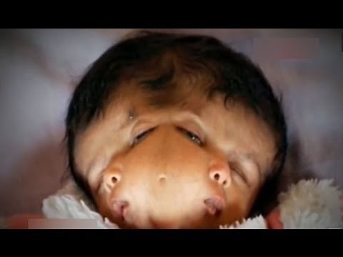 Miracle Baby With 2 Faces | Hope and Faith