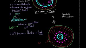 Arteriolosclerosis - part 2