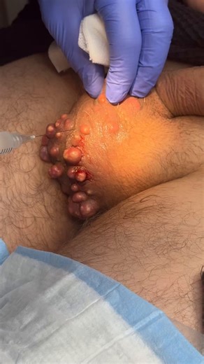 Treating and removing scrotal calcinosis in a male in his 20s presenting with multiple calcified nodules.Lesions were clustered, with several deeper nodules obscured beneath superficial deposits. Treatment will require staged excision to fully address both visible and subdermal involvement while preserving tissue integrity.