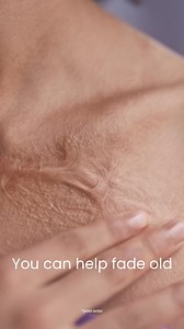 Mederma can help fade old and new scars–along with your doubts–in as little as 8 weeks. That’s the power of our Triple Action Formula. | Mederma