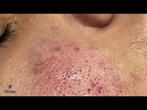 Squeeze Perennial Blackheads