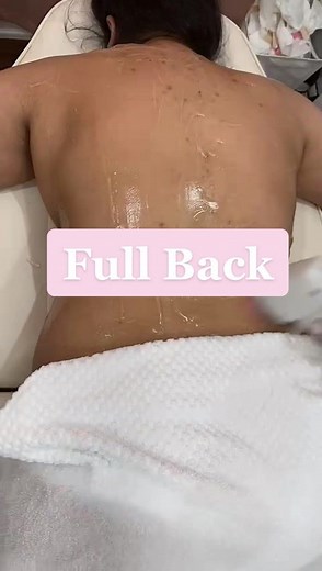 Full Back Laser Hair Removal✨ #laserhairremoval #laserhairremovaltreatment #laserhairremovalclinic #laserhair #torontobusinesswoman #laserhairremovaltoronto #laserhairremovalmississauga