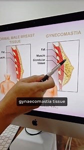 What’s the difference between a normal male breast tissue versus someone with #gynecomastia (man boobs)? Dr Ivan Puah clarifies. #Amarisbclinic #sgaestheticsclinic #drivanpuah #medicalcondition | Amaris B. Clinic