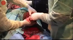 Syria Amputation Of Legs Operation