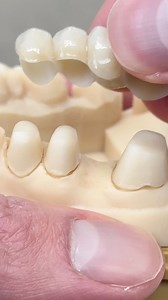 91K views · 18 reactions | Pontic Bridge with Telescopic Coping! @_etec_ | CEO Luke Kahng | Facebook