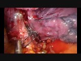 Subcostal Uniportal VATS Fissureless Left Lower Lobectomy • Video • MEDtube.net