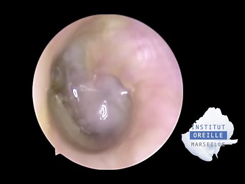 Perforated Purulent Otitis Media - Otite moyenne purulente perforée