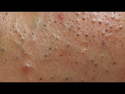 Daily Video Relaxing with Sophia Skin Care, Acne, Whiteheads & Blackheads #053