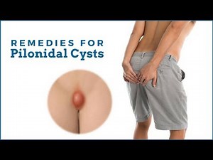 HOME REMEDIES FOR PILONIDAL CYSTS