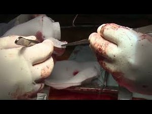 Personalized External Aortic Root Support (PEARS)