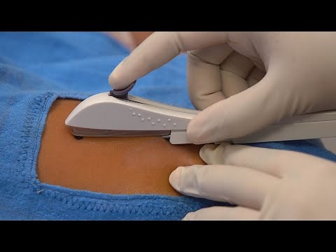 Inserting a One Rod Implant, Teaching Short (Health Workers), English - Family Planning Series