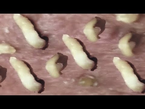 Amazing Blackheads Removal 2020