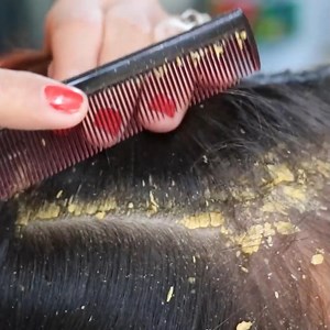 31K views · 38 reactions | Dandruff Scalp Satisfying Maggot Worms By Beautiful Girl #Dandruff Worm #HUGE FLAKE #DandruffBigFlakes #dandruffremoval #dandruffshampoo #dandruffproblems #dandrufftreatment | FreeQgame | Facebook