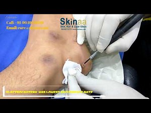 Dr Atul Jain Removing Wart via Electrocautery Method | Foot Wart Removal | Skinaa Clinic, Jaipur