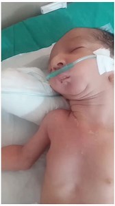 Pierre Robin syndrome (PRS)!! Difference between Sequence, Syndrome and Association . | Dr. Arshad Mehmood - Child Specialist