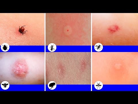 9 Most Painful Bites And Stings You Must Know