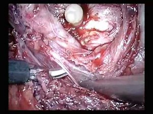 Intrafascial Nerve Sparing Endoscopic Extraperitoneal Radical Prostatectomy