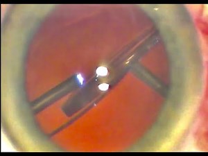Repositioning of dislocated IOL with optic capture in anterior capsulorhexis - Dr Simon Chen