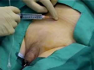 How to Insert a Foley Catheter Suprapubically