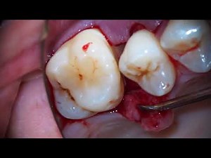 Periodontal regeneration