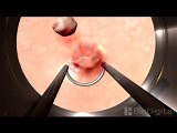 Bladder tumor Removal • Video • MEDtube.net