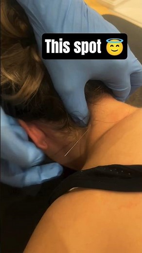 Tight Neck Muscles? Dry Needling Can Fix It! 😯