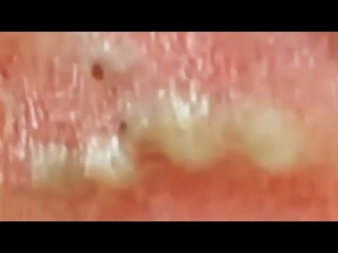 Deep blackhead extraction Cystic acne & pimple popping #88
