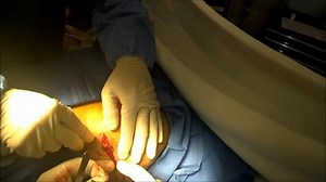 Breast Augmentation Revision Under Local Anesthesia — See This Woman's Procedure While She's Awake (GRAPHIC)