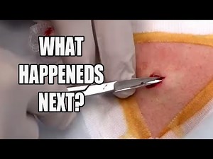 Cheeky Cyst Extraction! Dr Gilmore Extracts Cheek Cysts