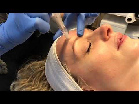 Microneedling - Non-Invasive Skin Care Treatment - Dr. Anthony Youn