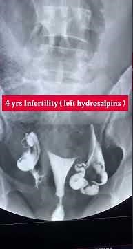 #HSG #Fluoroscopy #Radiology HSG (hydrosalpinx)