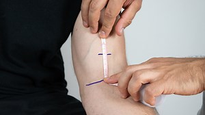 Biceps Crease Interval | Distal Biceps Tendon Rupture Assessment