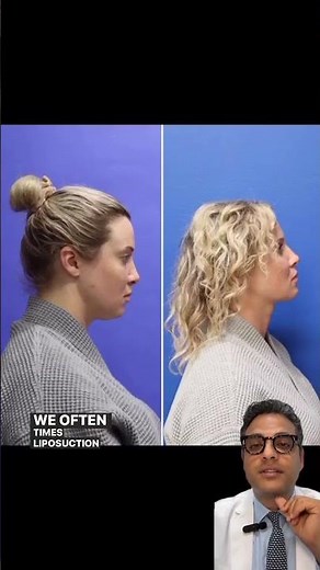 Neck Liposuction Before and After | Avance Plastic Surgery: Dr. Erez Dayan | Reno, Tahoe, NV