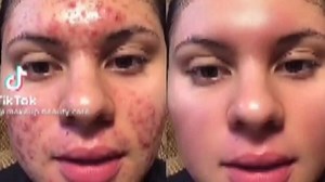 5.9K views · 20 reactions | Mask stick 3500 Whatsapp us on +234 802 740 4409 #acne #greenmaskstick | E Latest hairstyles & girls fashion | Facebook